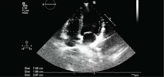 Transesophageal Echocardiogram